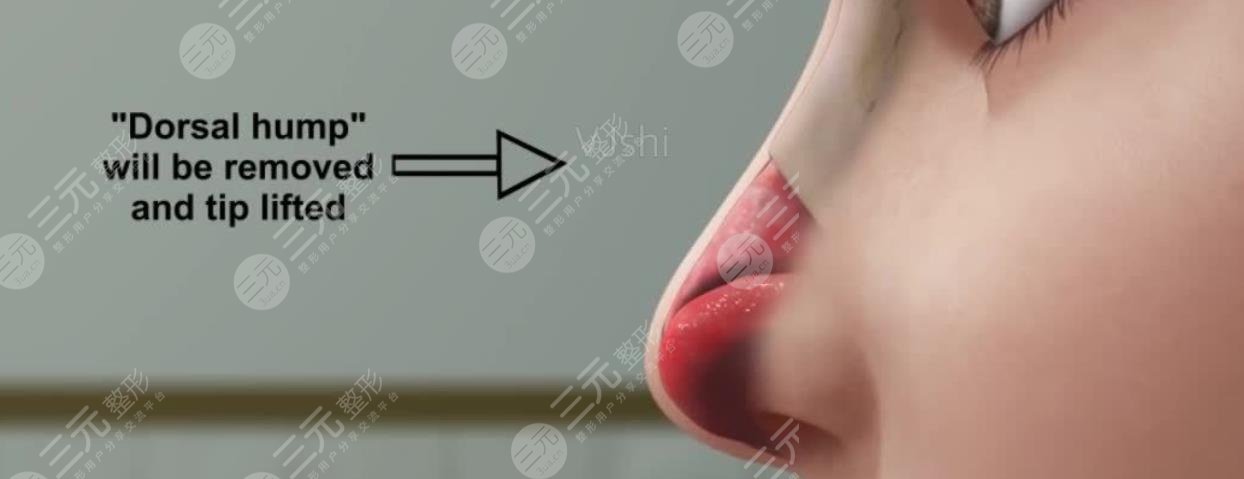 隆鼻