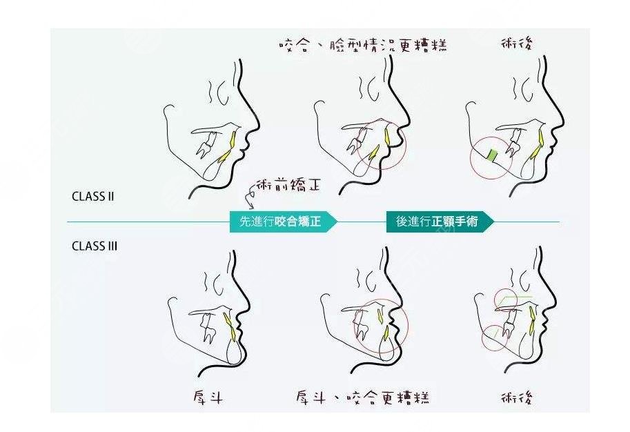 正頜手術(shù)風(fēng)險(xiǎn)大嗎