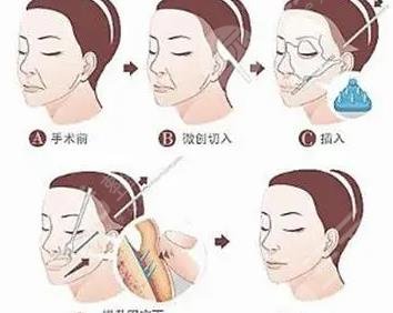 筋膜懸吊