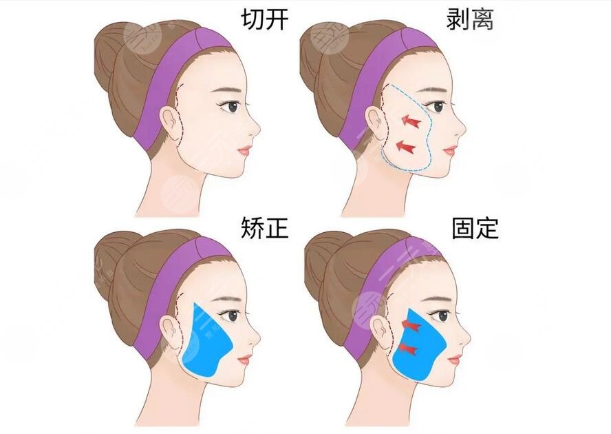 北醫(yī)三院拉皮手術多少錢?