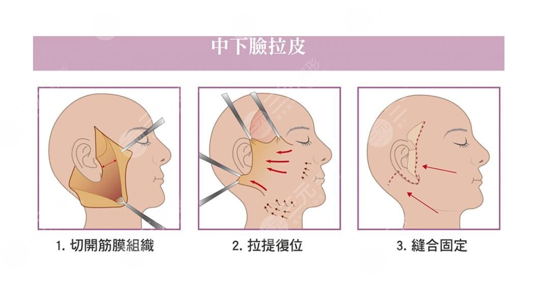 北醫(yī)三院拉皮手術多少錢?