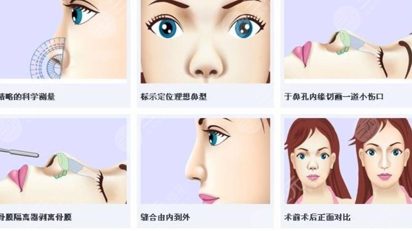 李海兵醫(yī)生做鼻子案例