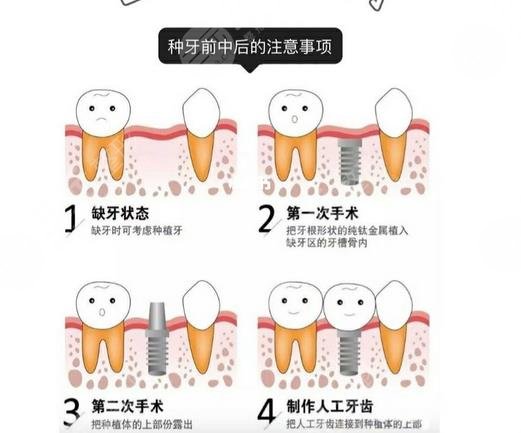 安徽省立醫(yī)院種牙哪個醫(yī)生好?