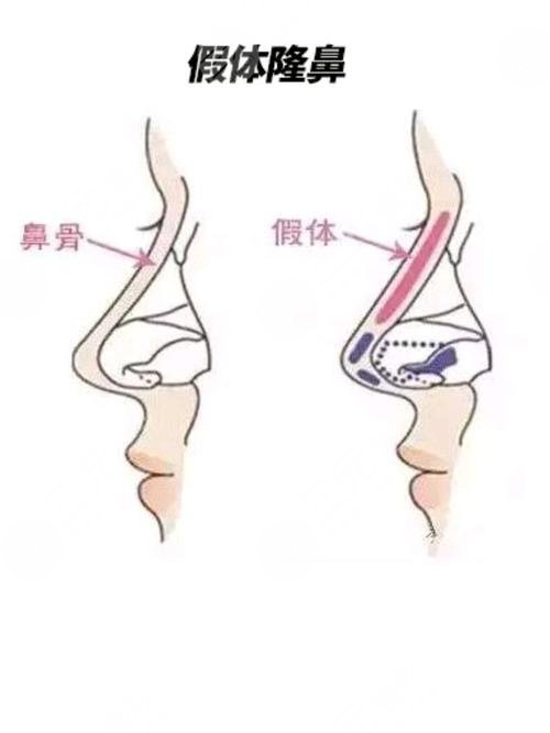 成都周順波做鼻子風格