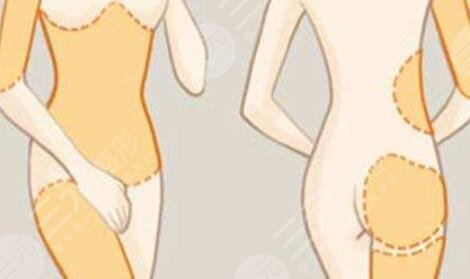 吸脂