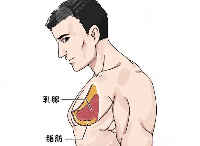 男生脂肪胸