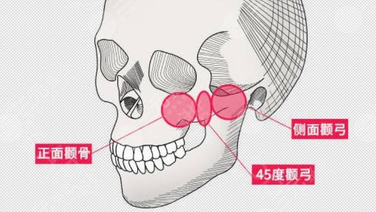 顴骨