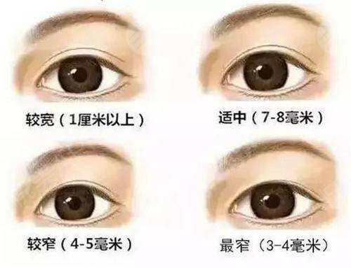 北京八大處靳小雷雙眼皮手術(shù)費貴嗎?