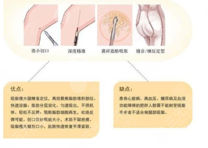 大腿抽脂