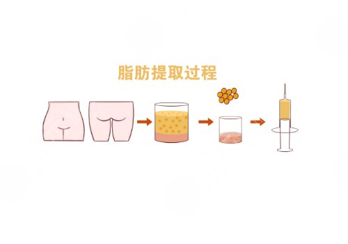 自體脂肪豐胸手術(shù)費(fèi)大概要多少錢