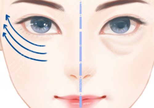 上海九院做眼袋手術多少錢 