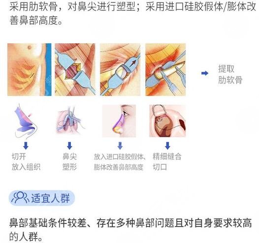 全肋骨隆鼻可以維持一輩子嗎