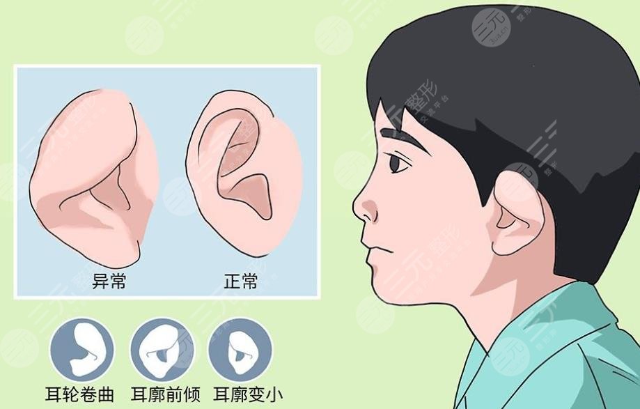 小耳畸形