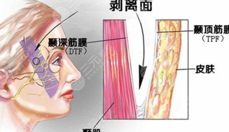 拉皮