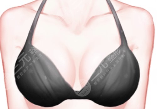 欒杰隆胸的價(jià)格