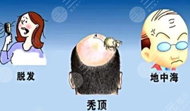 植發(fā)