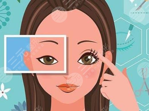 李力群醫(yī)生個性化雙眼皮案例