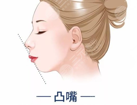 凸嘴正頜