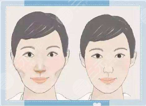 顴骨
