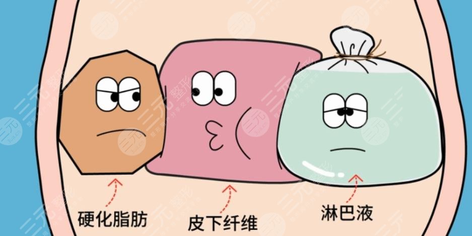 吸脂瘦腰