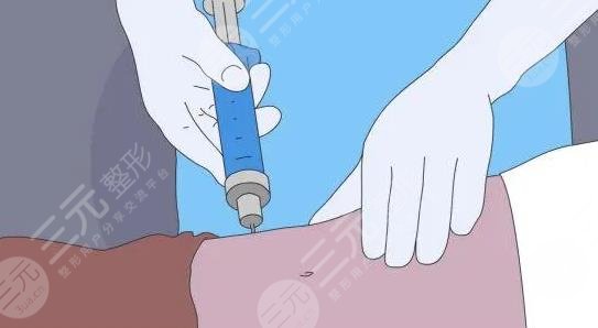 大腿吸脂