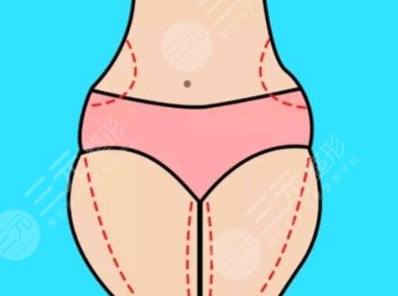 大腿吸脂