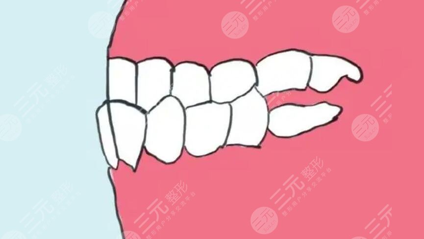 牙齒矯正