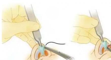 耳軟骨隆鼻