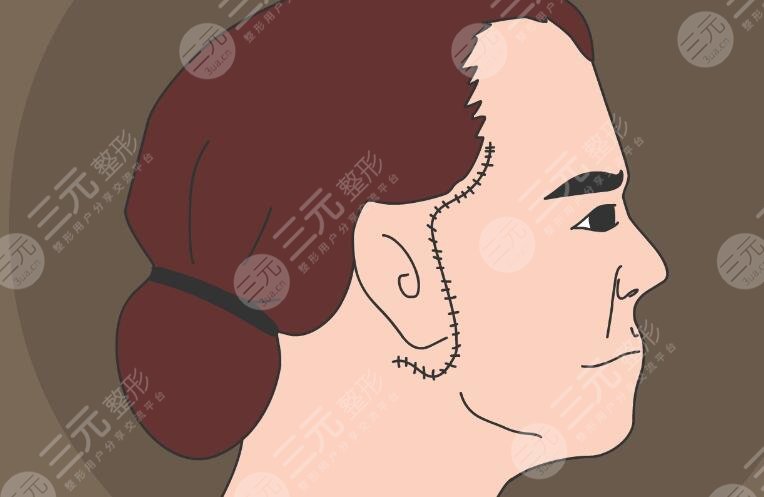 拉皮