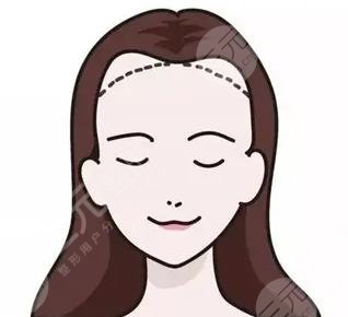 發(fā)際線