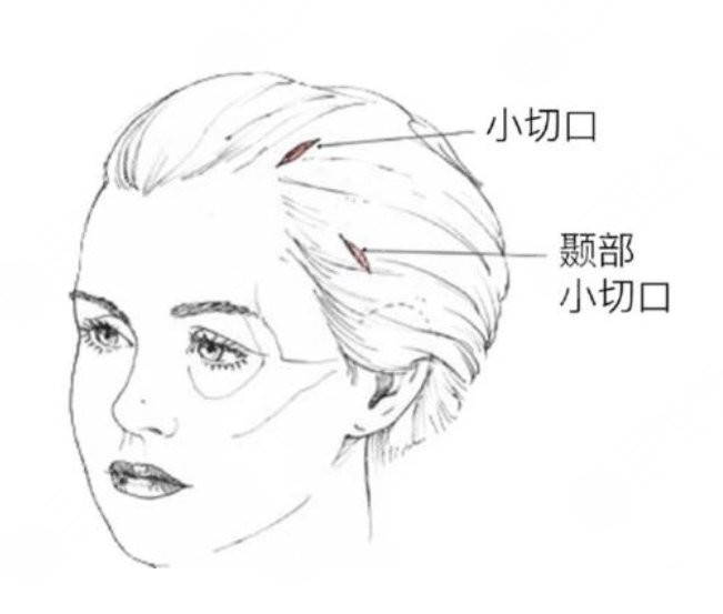 拉皮手術(shù)