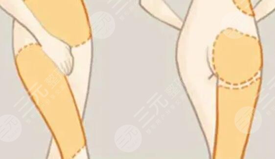 吸脂