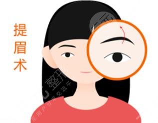 切眉術(shù)