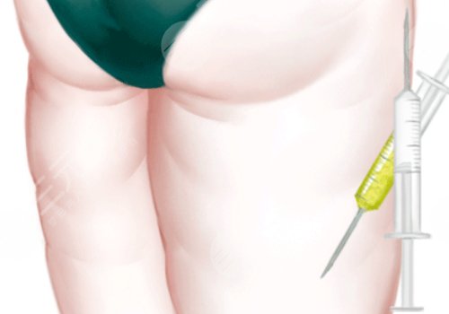 吸脂瘦大腿一般多少錢