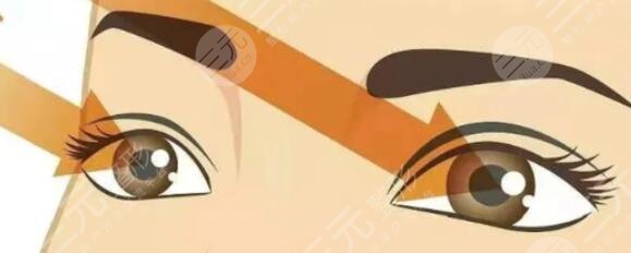 雙眼皮