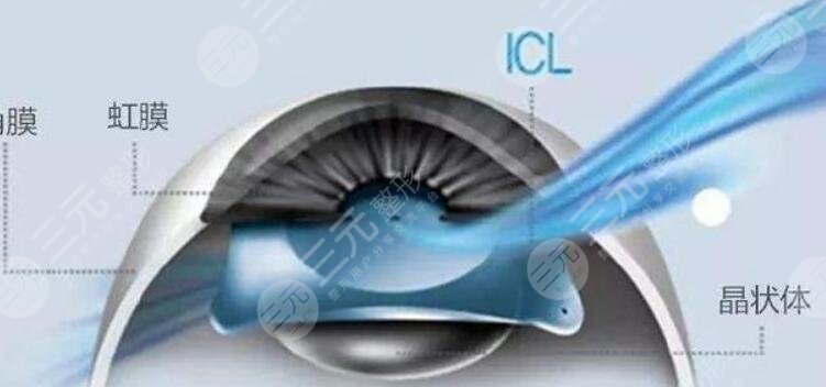 icl晶體