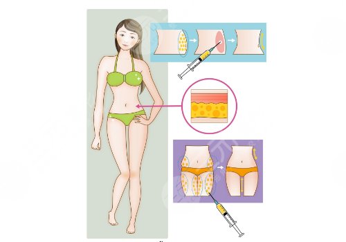 大腿抽脂的價(jià)格