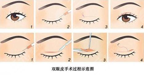臺州市立醫(yī)院美容科割雙眼皮怎么樣?