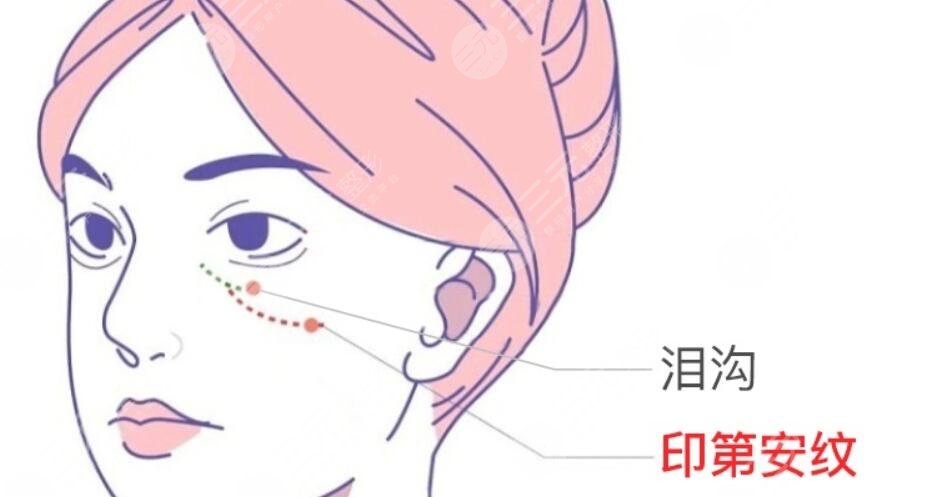 淚溝填充