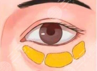 淚溝填充
