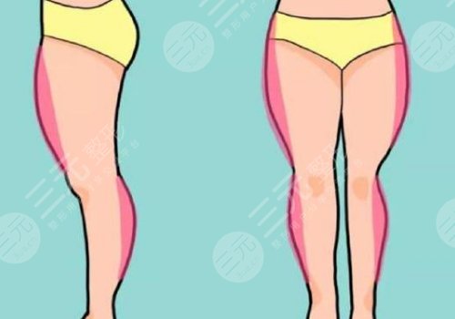大腿抽脂多少錢左右