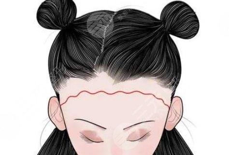 發(fā)際線
