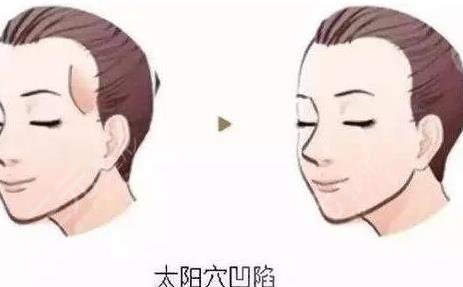 面部填充