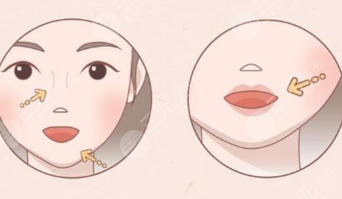紋唇手術(shù)