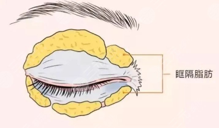 腫眼泡