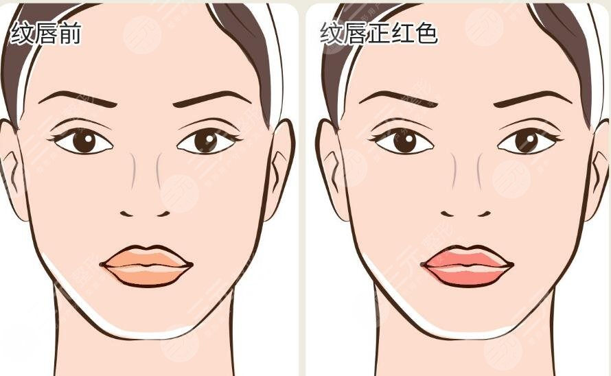 紋唇