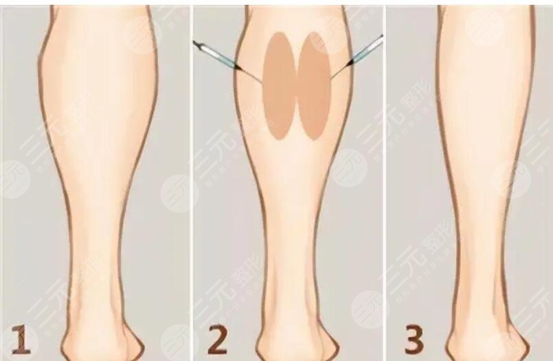 瘦腿