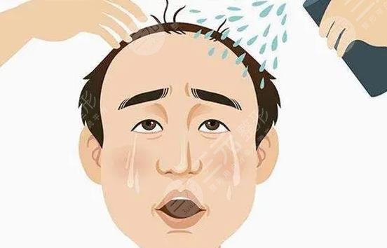 植發(fā)