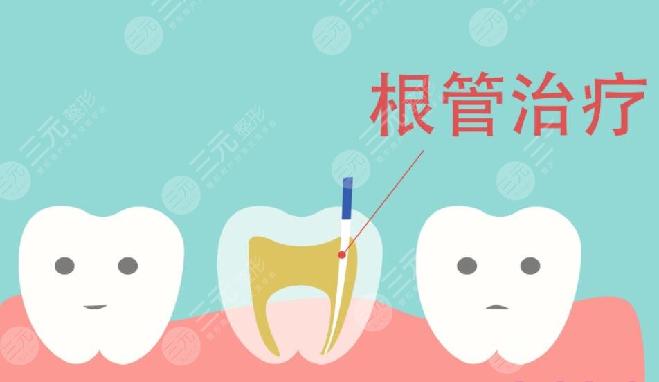 根管