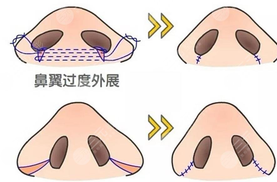 鼻翼